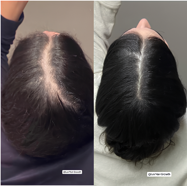 Suero para el crecimiento del cabello (3 meses)